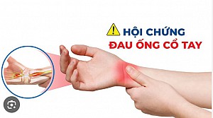 HỘI CHỨNG ỐNG CỔ TAY: NGUYÊN NHÂN, BIỂU HIỆN VÀ ĐIỀU TRỊ