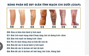 CÁC  CẤP ĐỘ SUY GIÃN TĨNH MẠCH CHI