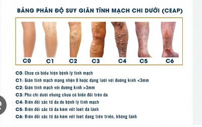 CÁC  CẤP ĐỘ SUY GIÃN TĨNH MẠCH CHI