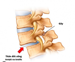 TRƯỢT ĐỐT SỐNG THẮT LƯNG