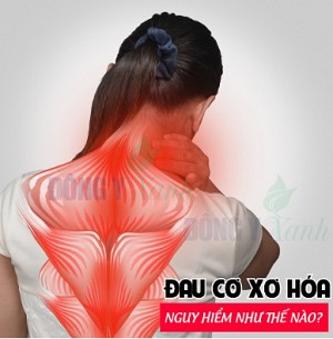 HỘI CHỨNG ĐAU XƠ CƠ VÙNG CỔ