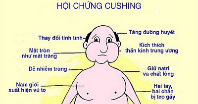 Sống Khỏe Với Bệnh Cushing: Hiểu Đúng, Ăn Đúng, Tập Đúng