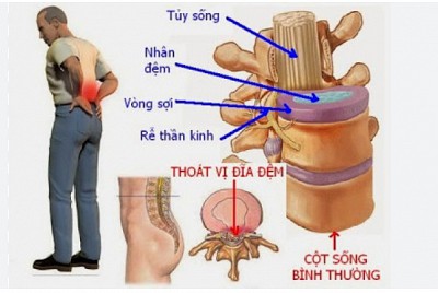 THOÁI VỊ ĐĨA ĐỆM THỂ TRUNG TÂM LÀ GÌ? NGUYÊN NHÂN VÀ CÁCH ĐIỀU TRỊ