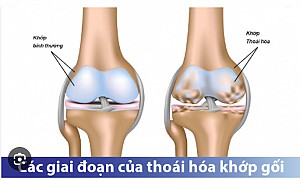 THOÁI HÓA KHỚP GỐI: NGUYÊN NHÂN, TRIỆU CHỨNG GIAI ĐOẠN BỆNH VÀ ĐIỀU TRỊ