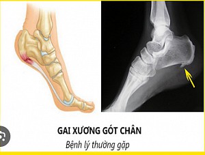 GAI GÓT CHÂN: NGUYÊN NHÂN, BIỂU HIỆN VÀ CÁCH ĐIỀU TRỊ