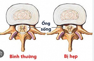 HẸP ỐNG SỐNG: NGUYÊN NHÂN, DẤU HIỆU, CHẨN ĐOÁN, ĐIỀU TRỊ