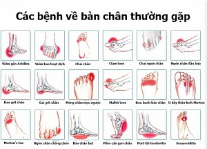 ĐAU BÀN CHÂN LÀ GÌ? NGUYÊN NHÂN, VỊ TRÍ ĐAU THƯỜNG GẶP, CHẨN ĐOÁN