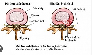 RÁCH BAO XƠ ĐĨA ĐỆM