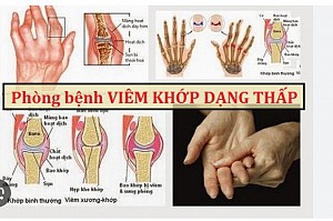 VIÊM KHỚP DẠNG THẤP: TRIỆU CHỨNG, NGUYÊN NHÂN VÀ CÁCH ĐIỀU TRỊ