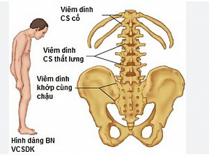 VIÊM CỘT SỐNG DÍNH KHỚP ẢNH HƯỞNG ĐẾN KHỚP HÁNG THẾ NÀO?