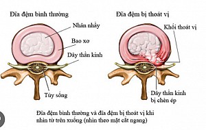 PHÁC ĐỒ ĐIỀU TRỊ THOÁT VỊ ĐĨA ĐỆM MỚI NHẤT (BỘ Y TẾ)