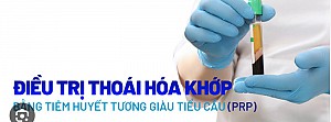 ĐIỀU TRỊ THOÁI HÓA KHỚP GỐI BẰNG PHƯƠNG PHÁP TIÊM HUYẾT TƯƠNG GIÀU TIỂU CẦU (PRP)