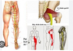 CÁCH PHÂN BIỆT ĐAU THẦN KINH TỌA VÀ HỘI CHỨNG PIRIFORMIS