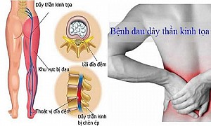 Yoga hỗ trợ giải phóng chèn ép thần kinh tọa: 6 tư thế an toàn và hiệu quả