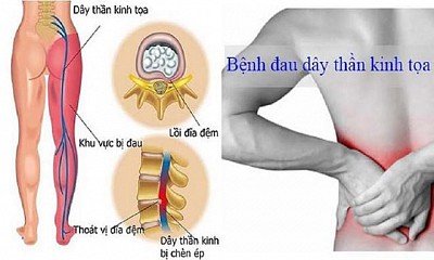 Yoga hỗ trợ giải phóng chèn ép thần kinh tọa: 6 tư thế an toàn và hiệu quả