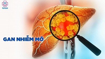 GAN NHIỄM MỠ: ĐỪNG CHỦ QUAN