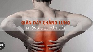 GIÃN DÂY CHẰNG, ĐAU THẮT LƯNG: NHỮNG ĐIỀU CẦN BIẾT