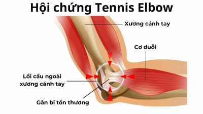 Vật Lý Trị Liệu Trong Hội Chứng Khuỷu Tay Tennis: Giải Pháp Phục Hồi Không Dùng Thuốc Hiệu Quả