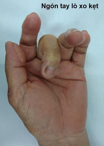 Vật lý trị liệu phục hồi hội chứng ngón tay lò xo: Giải pháp an toàn, hiệu quả, hạn chế tái phát