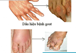 GOUT