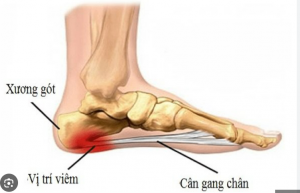 VIÊM CÂN GAN CHÂN: NGUYÊN NHÂN, TRIỆU CHỨNG, CHẨN ĐOÁN VÀ ĐIỀU TRỊ