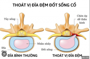 THOÁT VỊ ĐĨA ĐỆM CỔ C5 C6: NGUYÊN NHÂN, DẤU HIỆU VÀ PHÒNG NGỪA