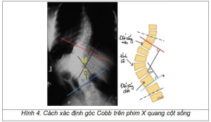 Những điều cần biết về cong vẹo cột sống và chỉ định phẫu thuật