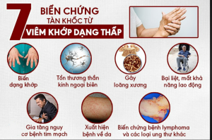 VIÊM KHỚP DẠNG THẤP: NGUYÊN NHÂN, TRIỆU CHỨNG, CHẨN ĐOÁN VÀ ĐIỀU TRỊ