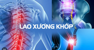 LAO XƯƠNG KHỚP