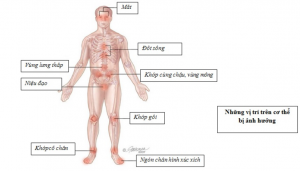 BỆNH VIÊM KHỚP PHẢN ỨNG