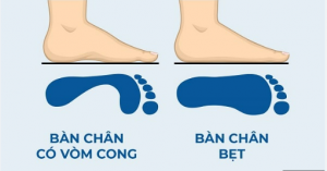 HỘI CHỨNG BÀN CHÂN BẸT