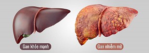 Gan nhiễm mỡ: không béo vẫn mắc bệnh?