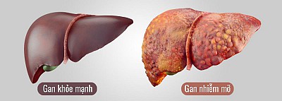 Gan nhiễm mỡ: không béo vẫn mắc bệnh?