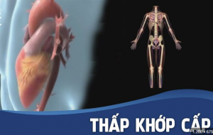 THẤP KHỚP CẤP