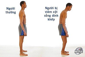 VIÊM CỘT SỐNG DÍNH KHỚP