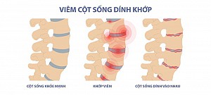 Viêm Cột Sống Dính Khớp: Hiểu Rõ Để Điều Trị Hiệu Quả