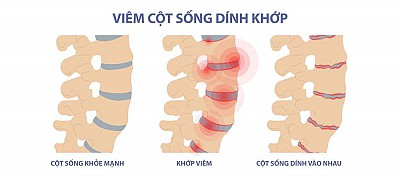 Viêm Cột Sống Dính Khớp: Hiểu Rõ Để Điều Trị Hiệu Quả