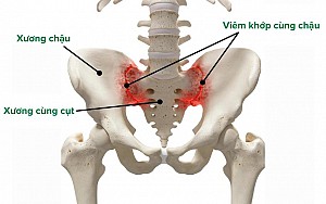 CÁC TƯ THẾ YOGA HỖ TRỢ ĐIỀU TRỊ VIÊM KHỚP CÙNG CHẬU
