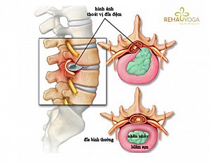 Thoát vị đĩa đệm: Nguyên nhân, triệu chứng, chẩn đoán