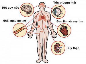 Tăng huyết áp: Kiến thức bệnh học toàn diện